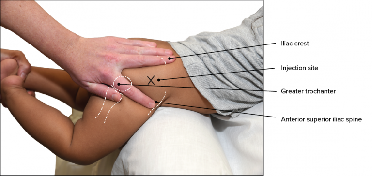 Photograph of an infant showing the ventrogluteal injection site