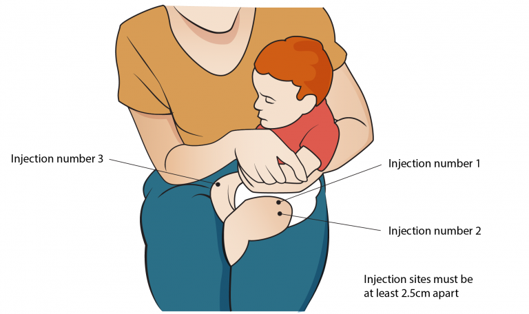 An infant is being held in the cuddle position for children <12 months old for an anterolateral thigh injection. Two injection sites are in the same thigh, at least 2.5 cm apart. The third injection should go into the other thigh