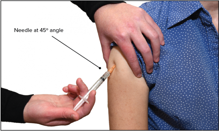 An adult is receiving a subcutaneous injection in the deltoid. The injection is inserted with the needle upwards into the deltoid, at a 45 degree angle to the arm.